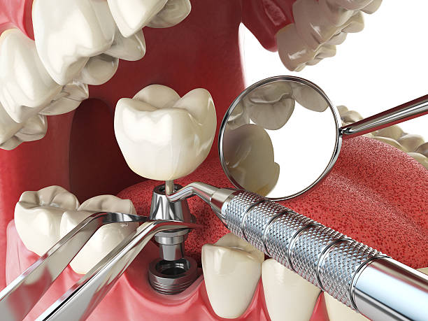 Best Emergency Wisdom Teeth Removal in Croom, MD